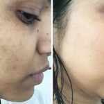 Getting rid of black spots from face has now become easy