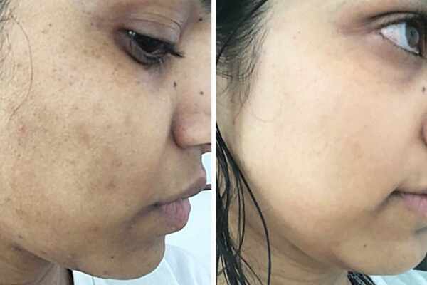 how to remove black spots on face