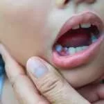 3 Most Common Reaons Why Baby Teeth Don't Fall Out