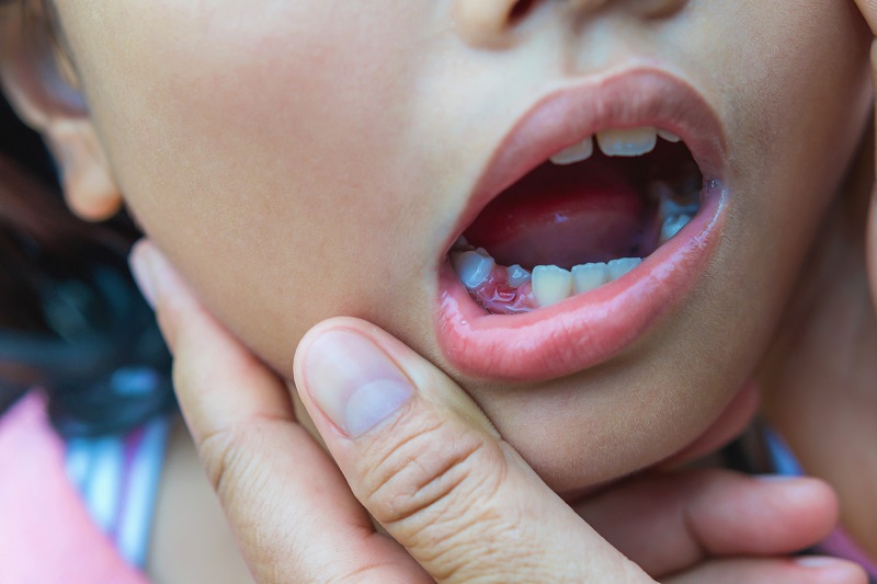 Why Baby Teeth Don't Fall Out