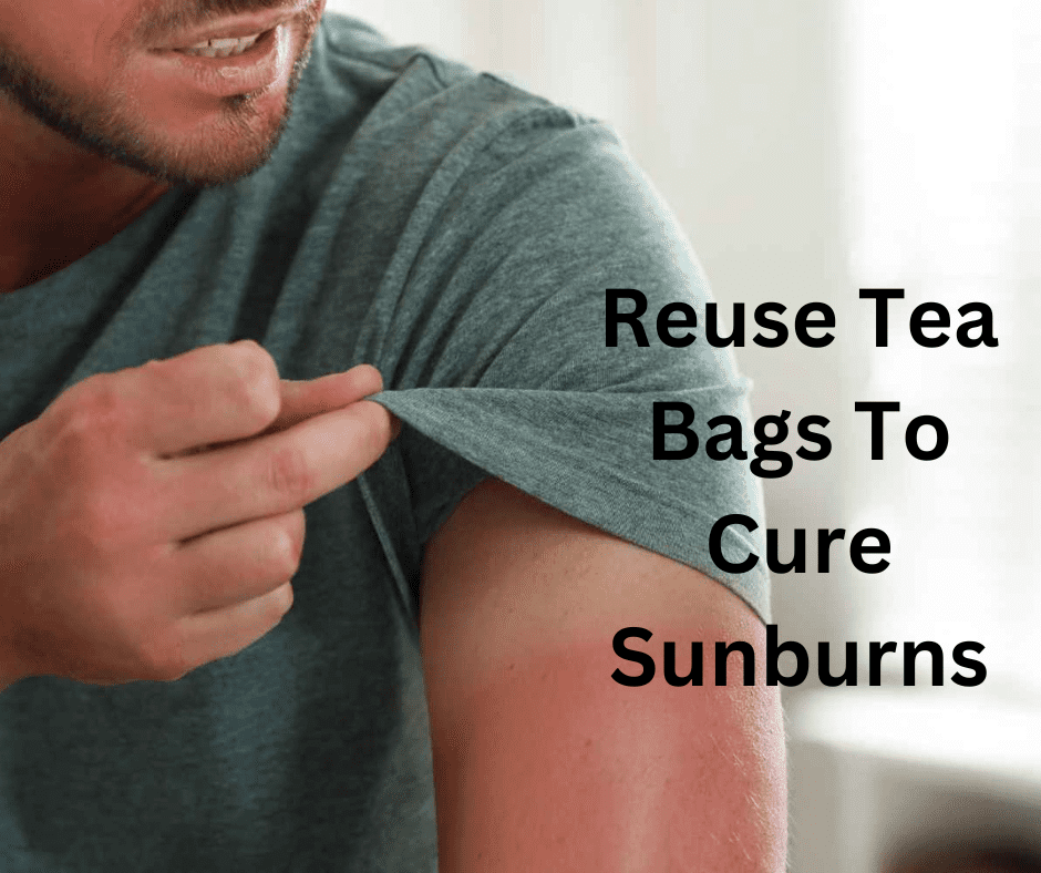 tea bags to treat sunburns